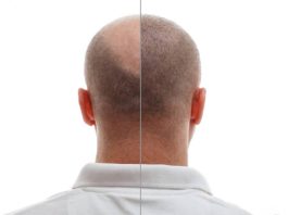 Hair Transplant: The Path to Restoring Your Natural Confidence with TrichoHom Hair transplant