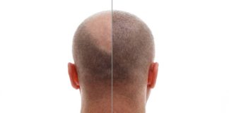 Hair Transplant: The Path to Restoring Your Natural Confidence with TrichoHom Hair transplant