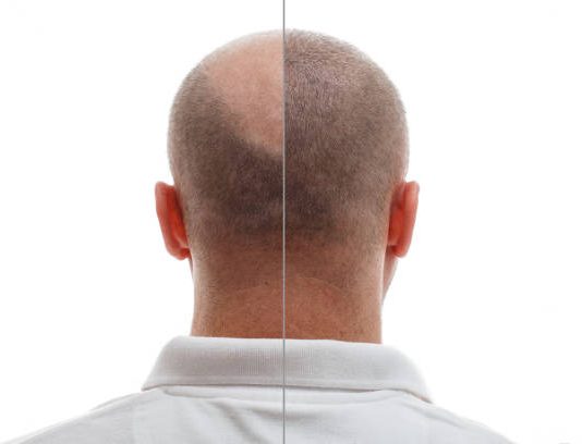 Hair Transplant: The Path to Restoring Your Natural Confidence with TrichoHom Hair transplant