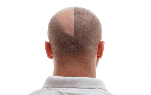 Hair Transplant: The Path to Restoring Your Natural Confidence with TrichoHom Hair transplant